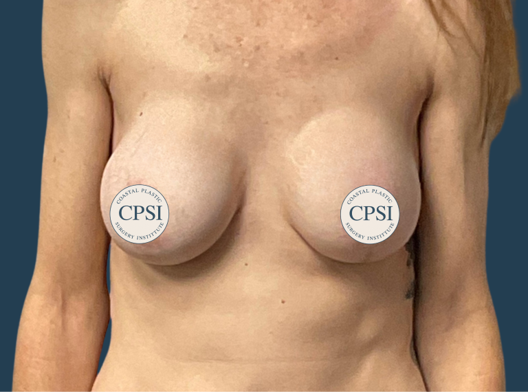 After Image: Breast Lift - front