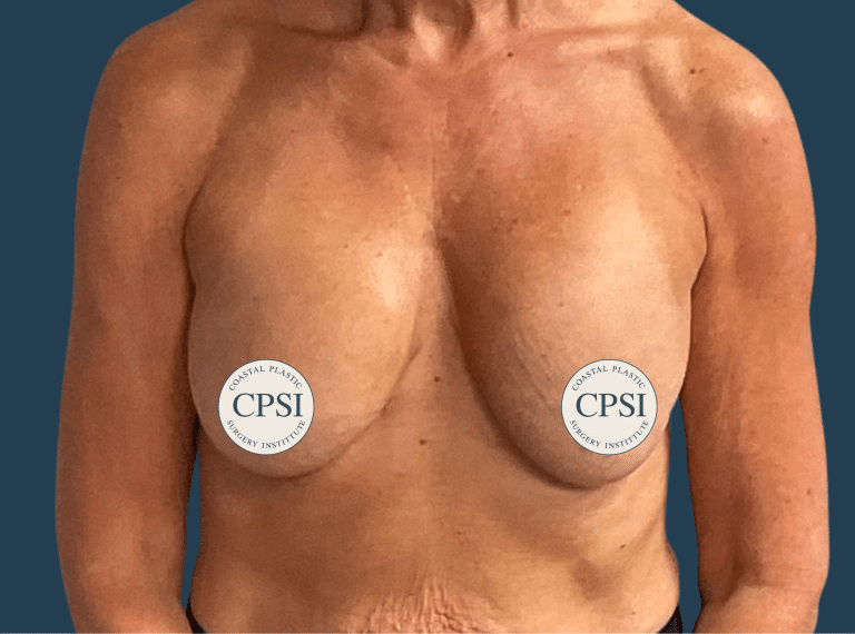 Before Image: Breast Lift - front