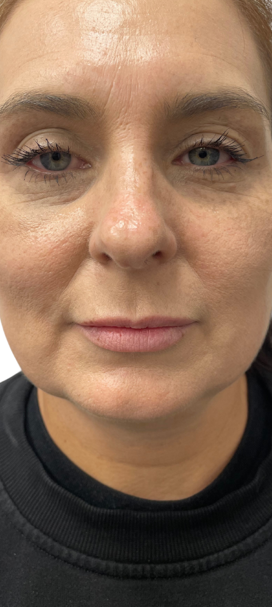 Before Image: Lip Filler - front