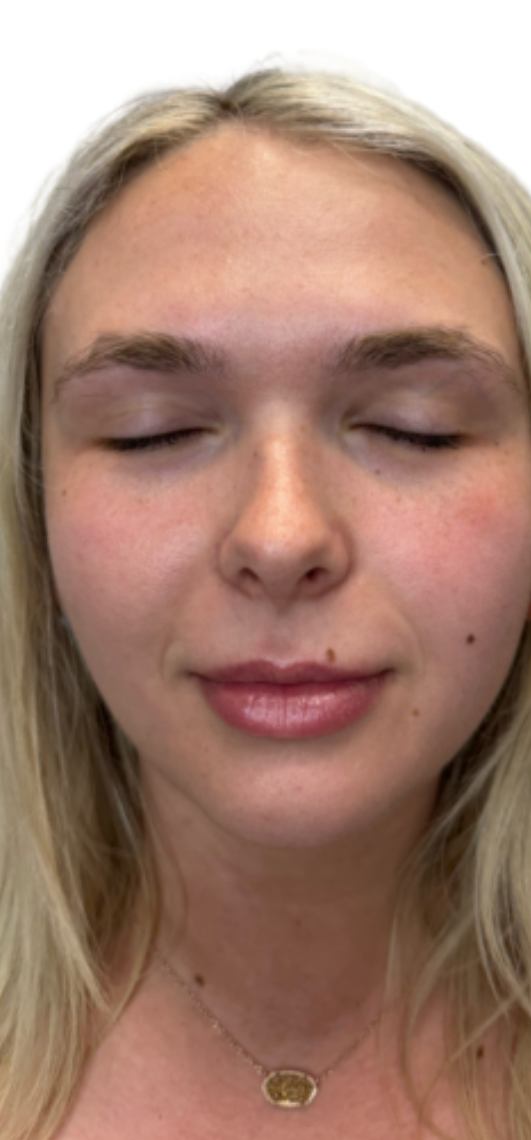 Before Image: Lip Filler - front