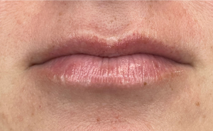 Before Image: Lip Filler