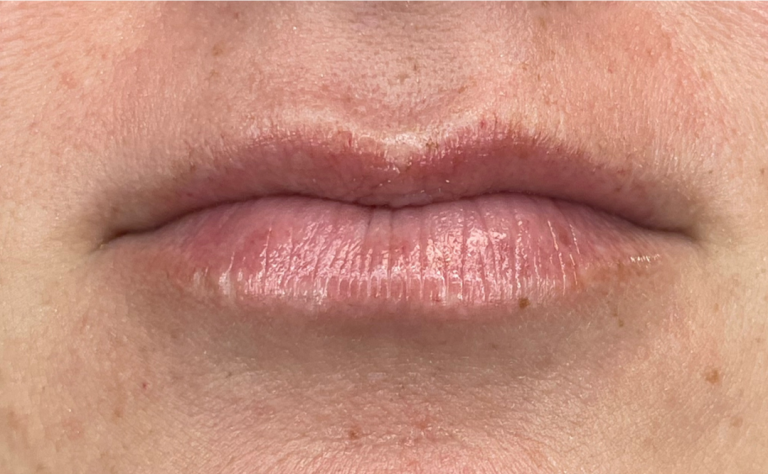 Before Image: Lip Filler - front