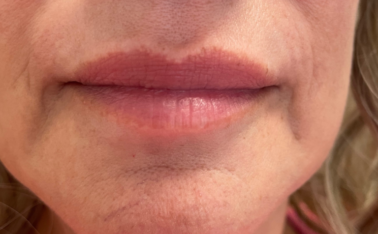 Before Image: Lip Filler - front