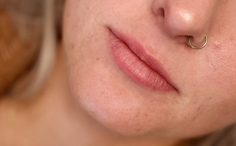 Before Image: Lip Filler - front