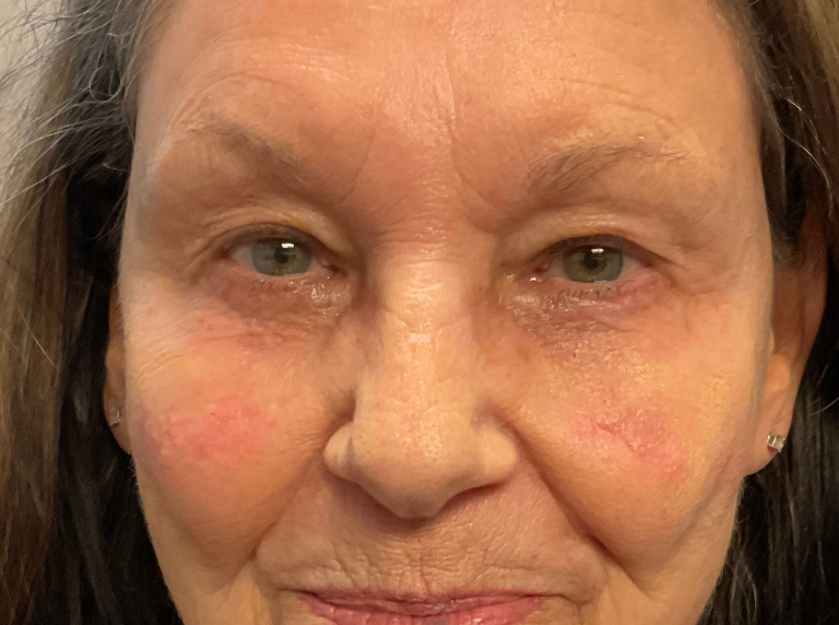 Before Image: Eyelid Surgery - front