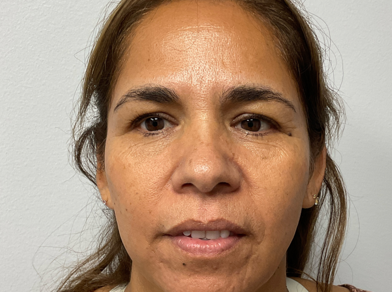 Before Image: Eyelid Surgery - front