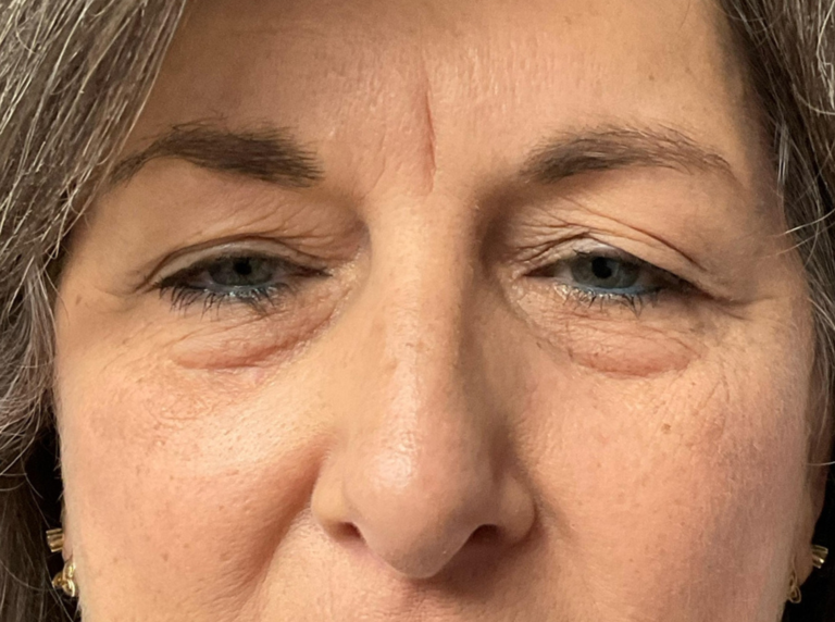Before Image: Eyelid Surgery - front