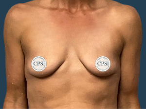 Before Image: Breast Augmentation
