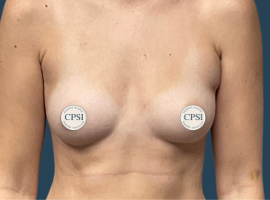 Before Image: Breast Augmentation