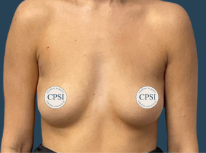 Before Image: Breast Augmentation