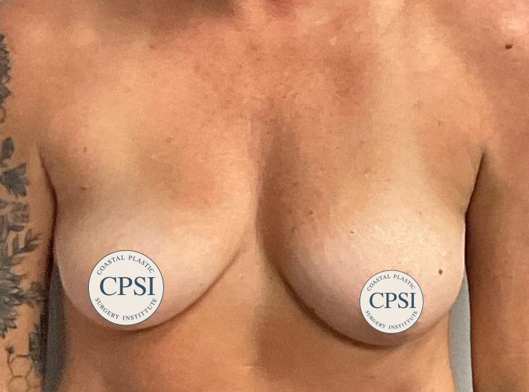 Before Image: Breast Lift - front