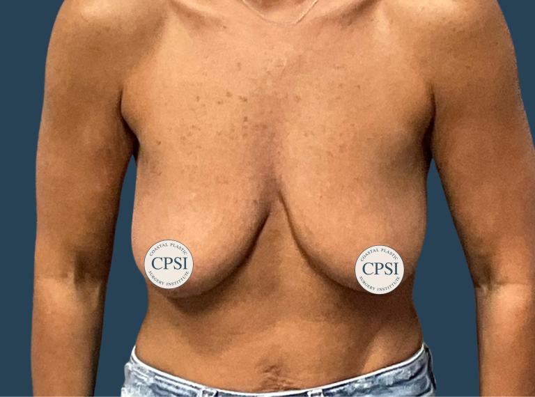 Before Image: Breast Lift - front