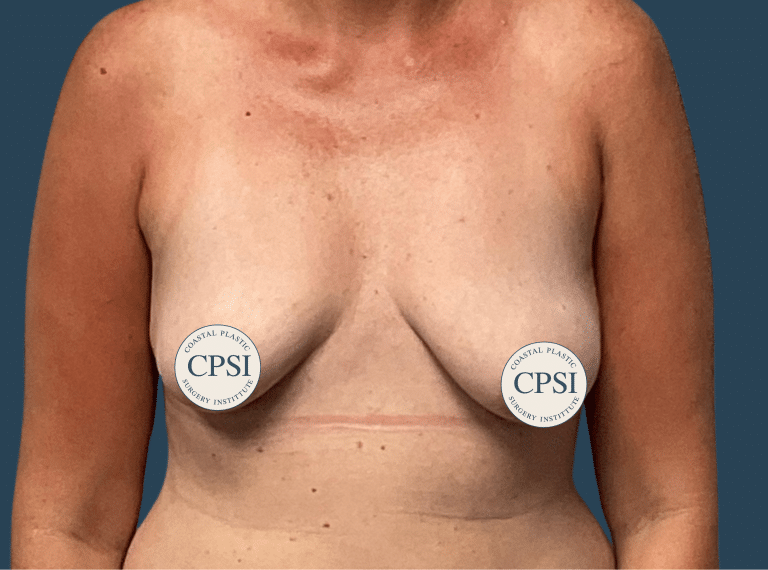 Before Image: Breast Lift - front
