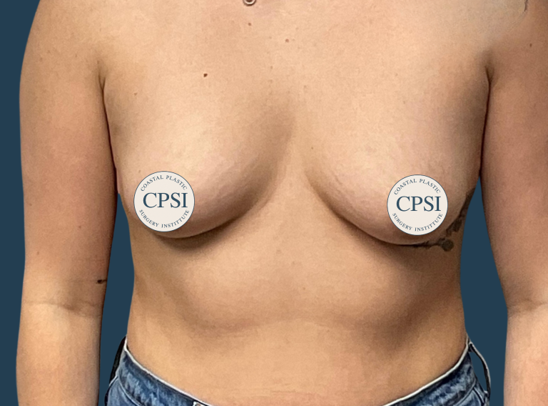 Before Image: Breast Augmentation - front