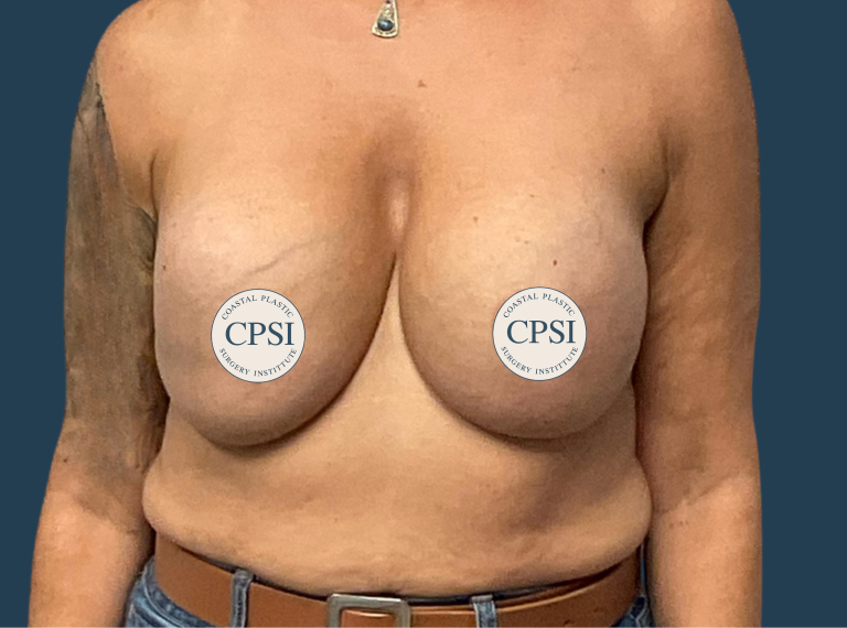 Before Image: Breast Lift - front