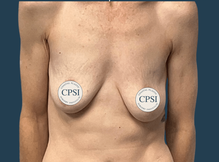 Before Image: Breast Lift - front