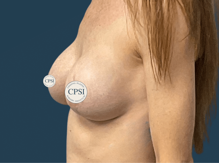 After Image: Breast Lift - left-front-oblique