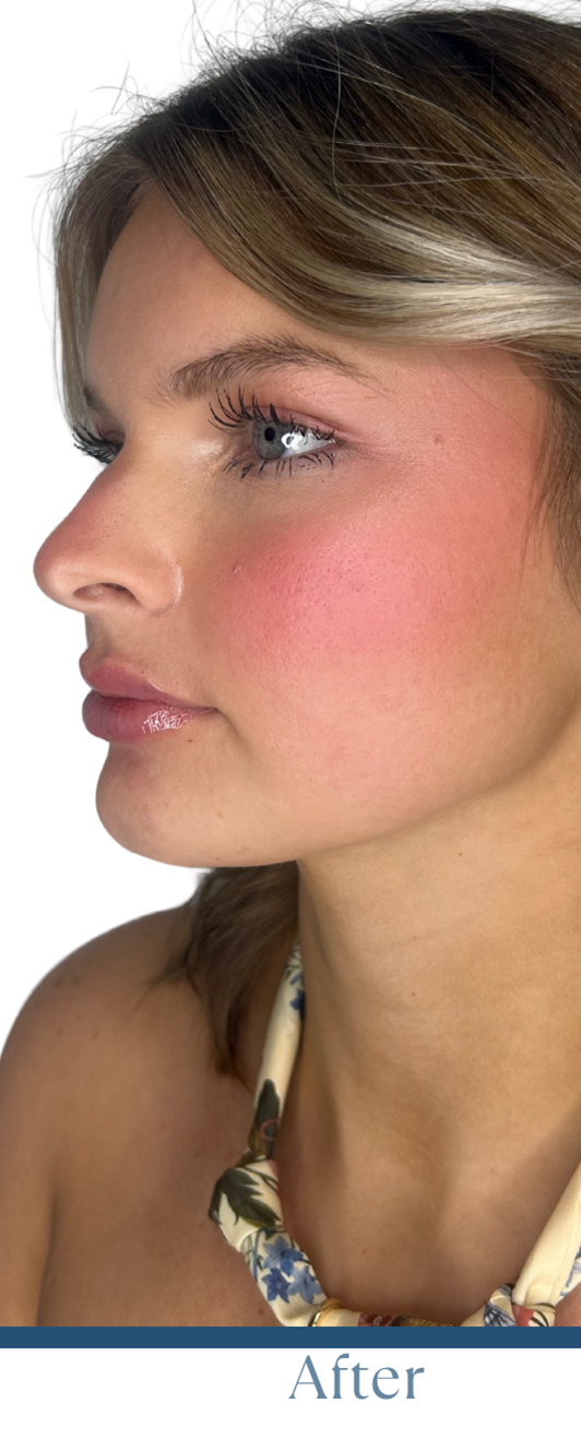 After Image: Lip FIller - left-front-oblique