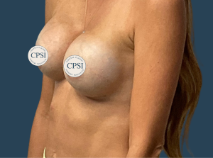 After Image: Breast Augmentation