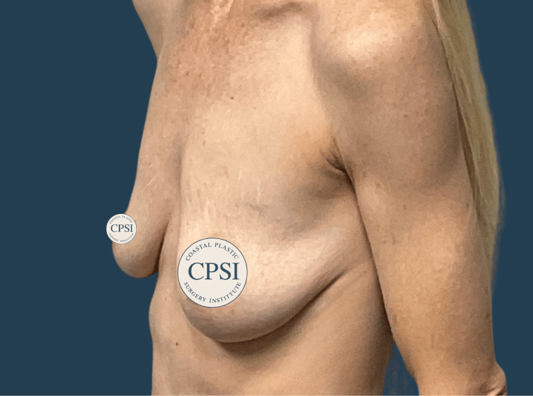 Before Image: Breast Lift - left-front-oblique