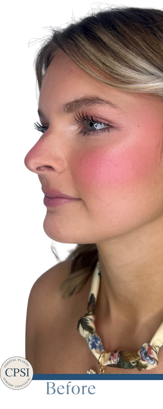 Before Image: Lip FIller - left-front-oblique