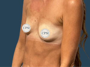 Before Image: Breast Augmentation