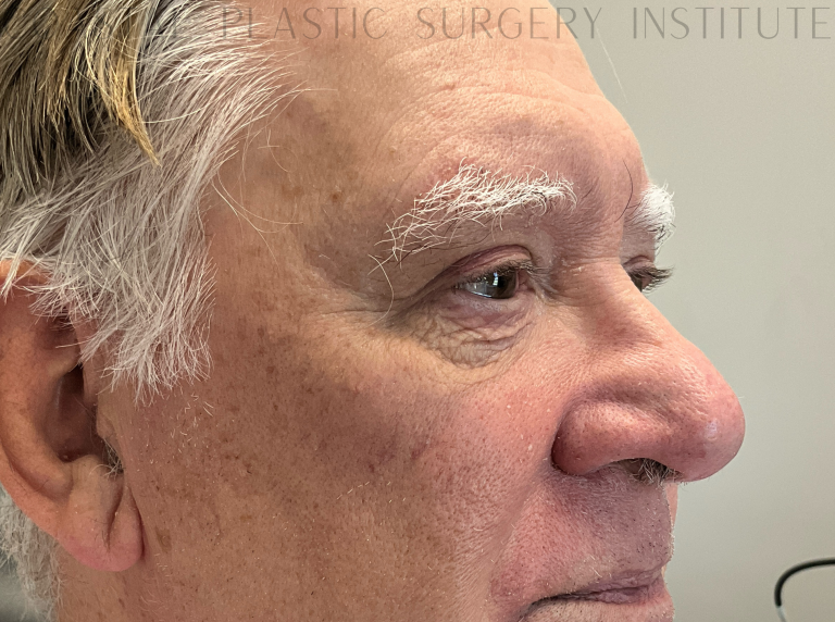 After Image: Eyelid Surgery - right-front-oblique
