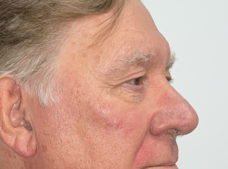 Before Image: Eyelid Surgery - right-front-oblique