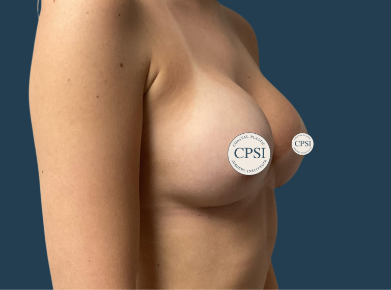 After Image: Breast Augmentation - right-front-oblique