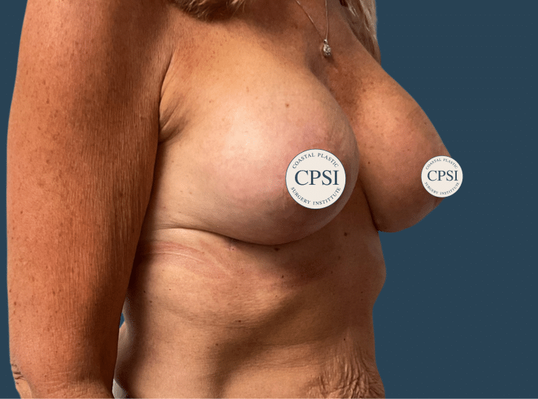 After Image: Breast Lift - right-front-oblique