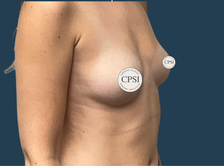 Before Image: Breast Augmentation - right-front-oblique