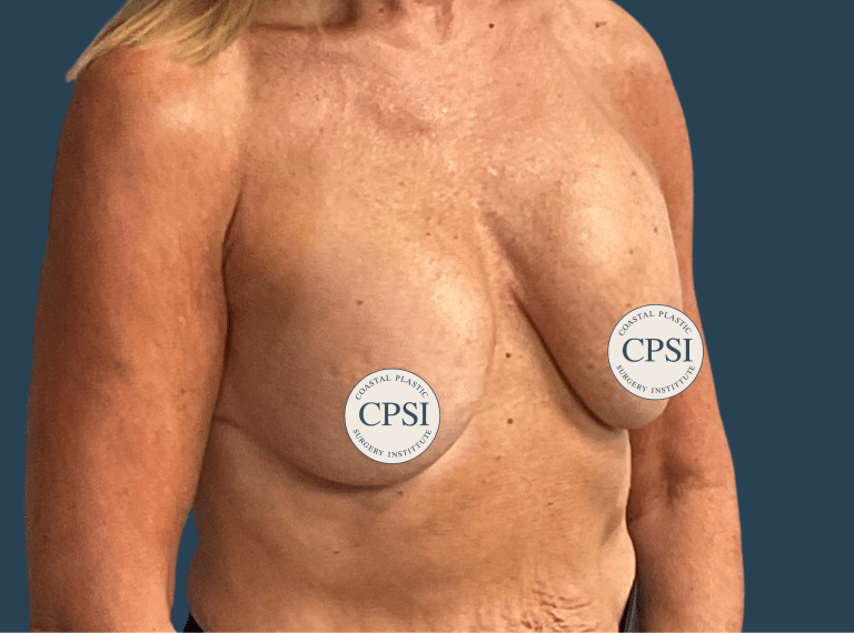Before Image: Breast Lift - right-front-oblique